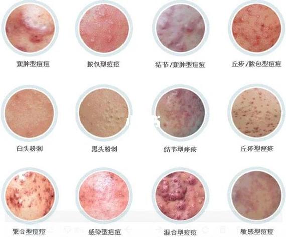 人体面部与手部皮脂腺分布对比图