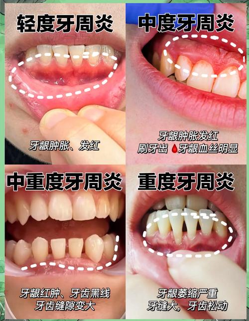 健康牙周与牙周炎牙缝对比图