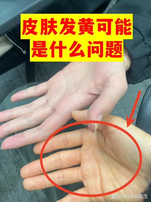 黄变到底是个啥？