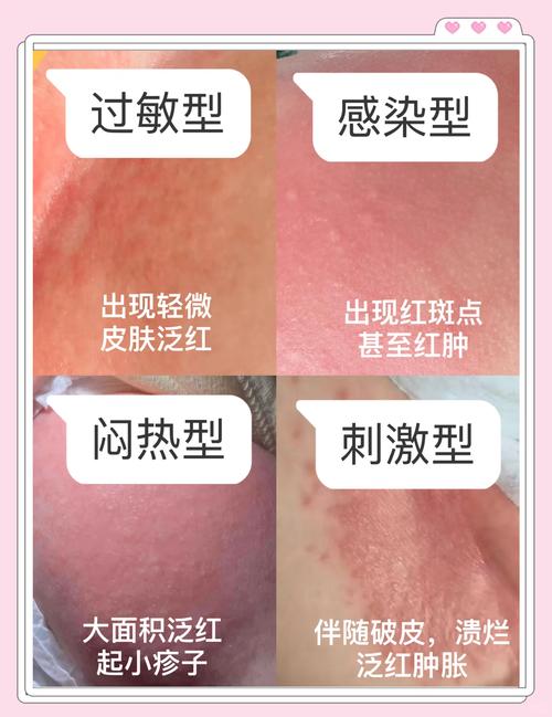黄疸、湿疹、红屁屁……处处是战场