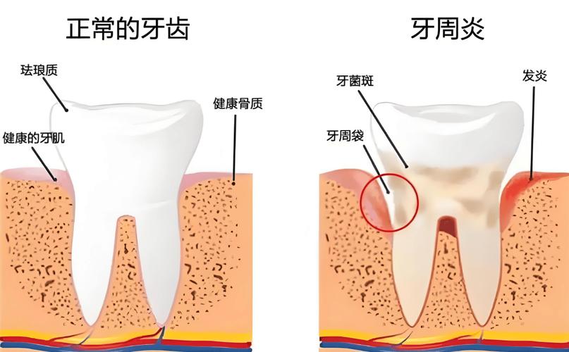 牙周健康状态与牙周袋结构对比示意图