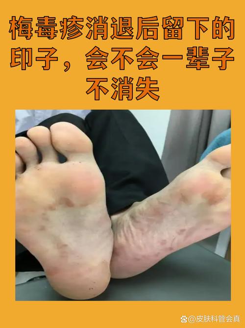 留了一辈子的印子