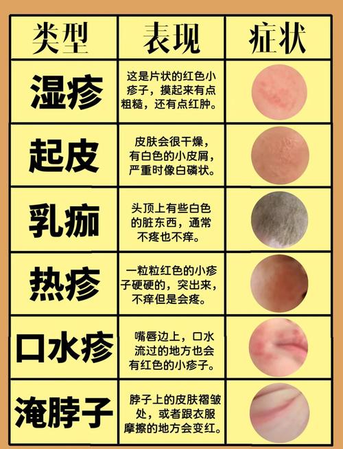 婴幼儿湿疹家长常见误区对照表
