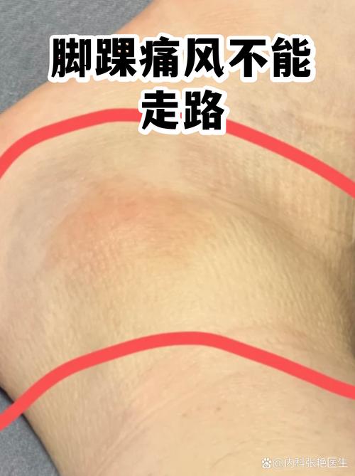 痛风急性期脚踝关节肿胀示意图