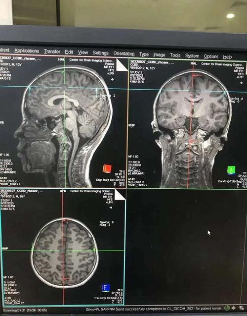 长期赌博者大脑前额叶对比核磁片