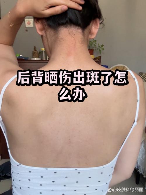 晒伤后背脱皮后留下的色素沉着对比照