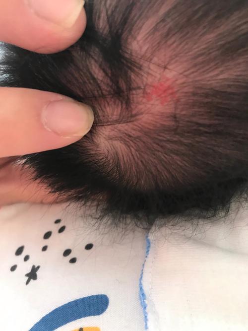 满月宝宝剃发后泛红脓疱头皮实拍