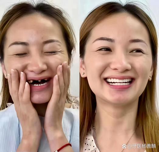 新娘手持牙齿美白仪微笑对比照