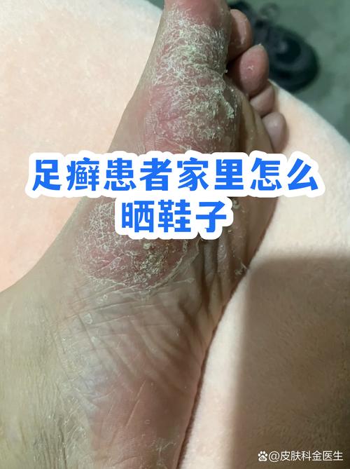 足癣患者阳台晾晒清洁鞋袜场景