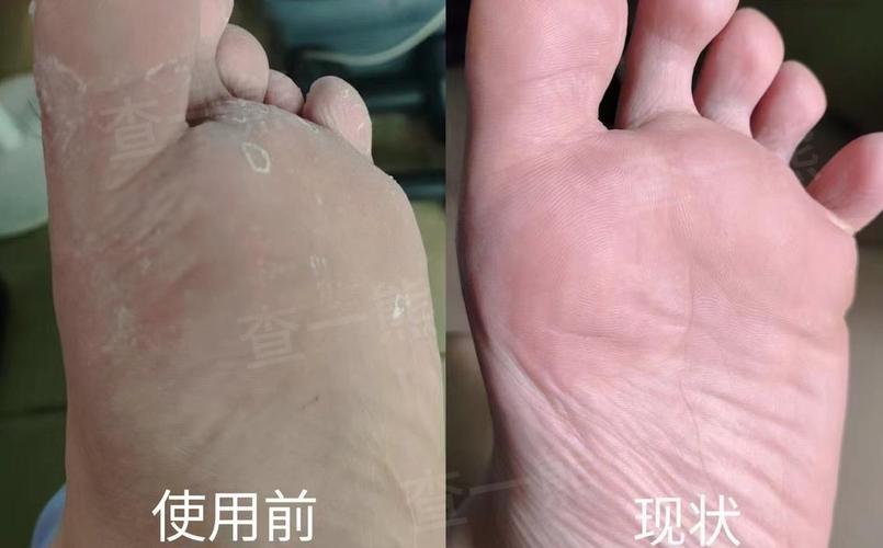 健康足部与干燥脱皮足部对比图