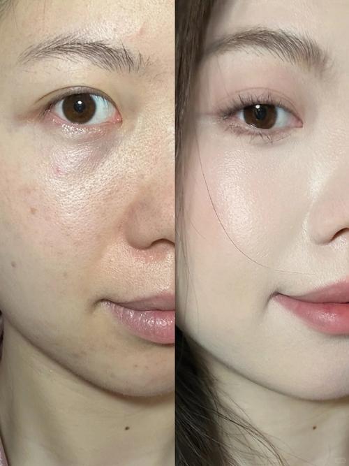 面部皮肤角质层过度水合前后状态对比实拍图