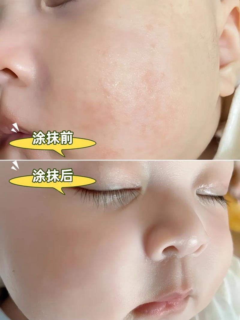 过敏宝宝湿疹厚涂保湿霜示范图