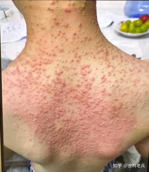 接触性皮炎患者背部红疹实拍