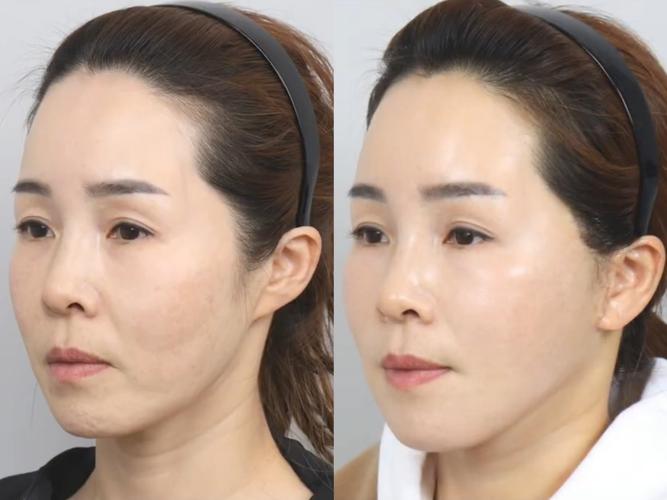 微电流美容仪提拉面部线条使用前后对比