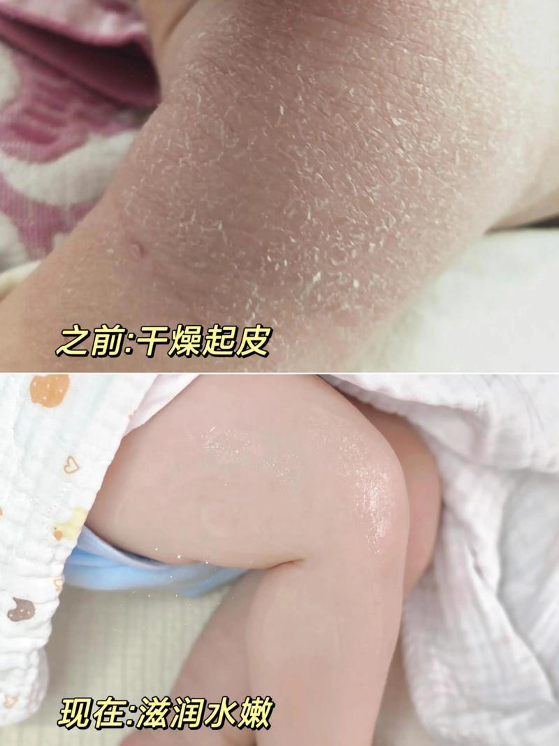 特应性皮炎儿童的身体乳涂抹频率:灵活调整比死守规矩更重要-仁者医