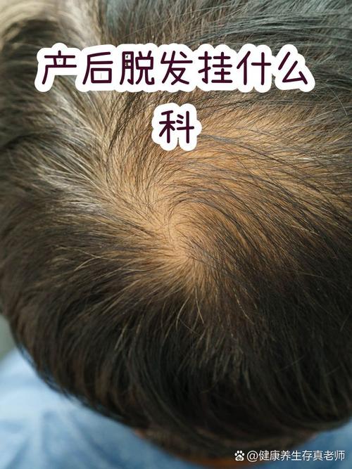 什么情况的产后脱发需要找医生？