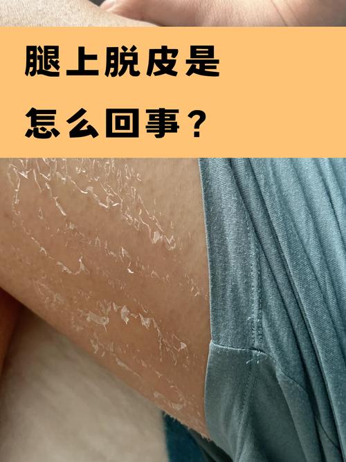 干燥季节腿部干皮掉屑实拍