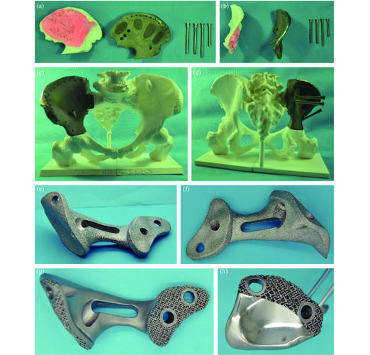 定制化钛合金骨盆植入物3D打印过程