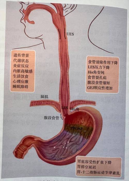平躺状态胃食管反流人体解剖示意图