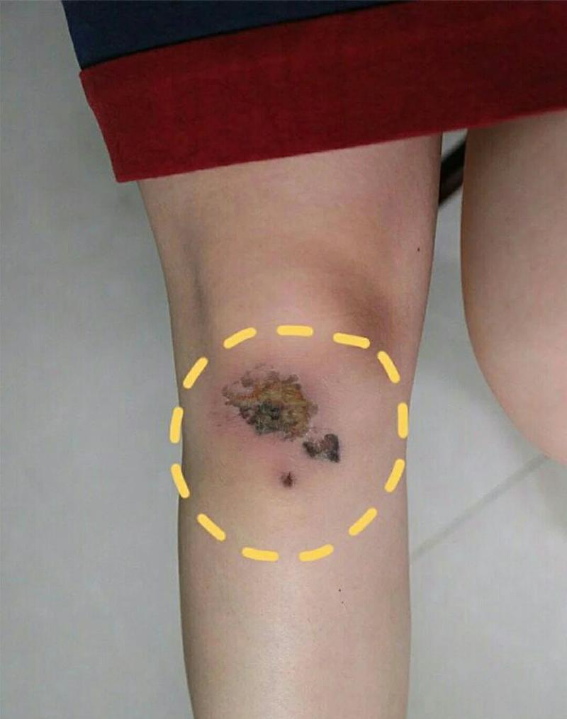 摔后留疤?这几个坑千万别踩