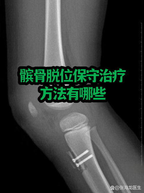 得了髌骨脱位到底要不要手术？