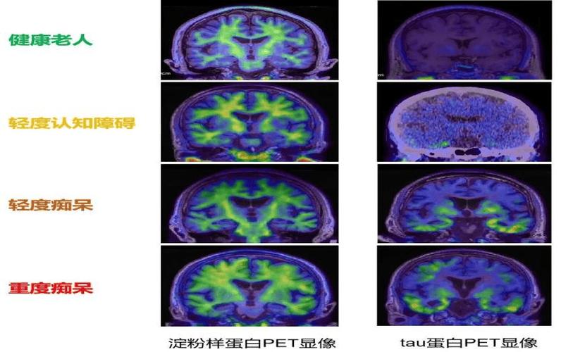 那个折磨千万人的记忆窃贼，终于被这项科研成果抓住了尾巴