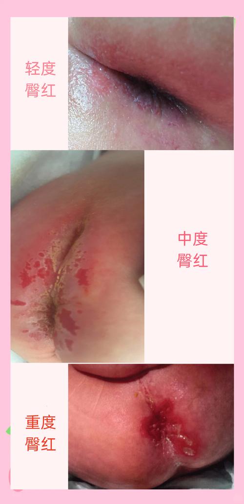 不能硬扛的宝宝臀部护理就医红线