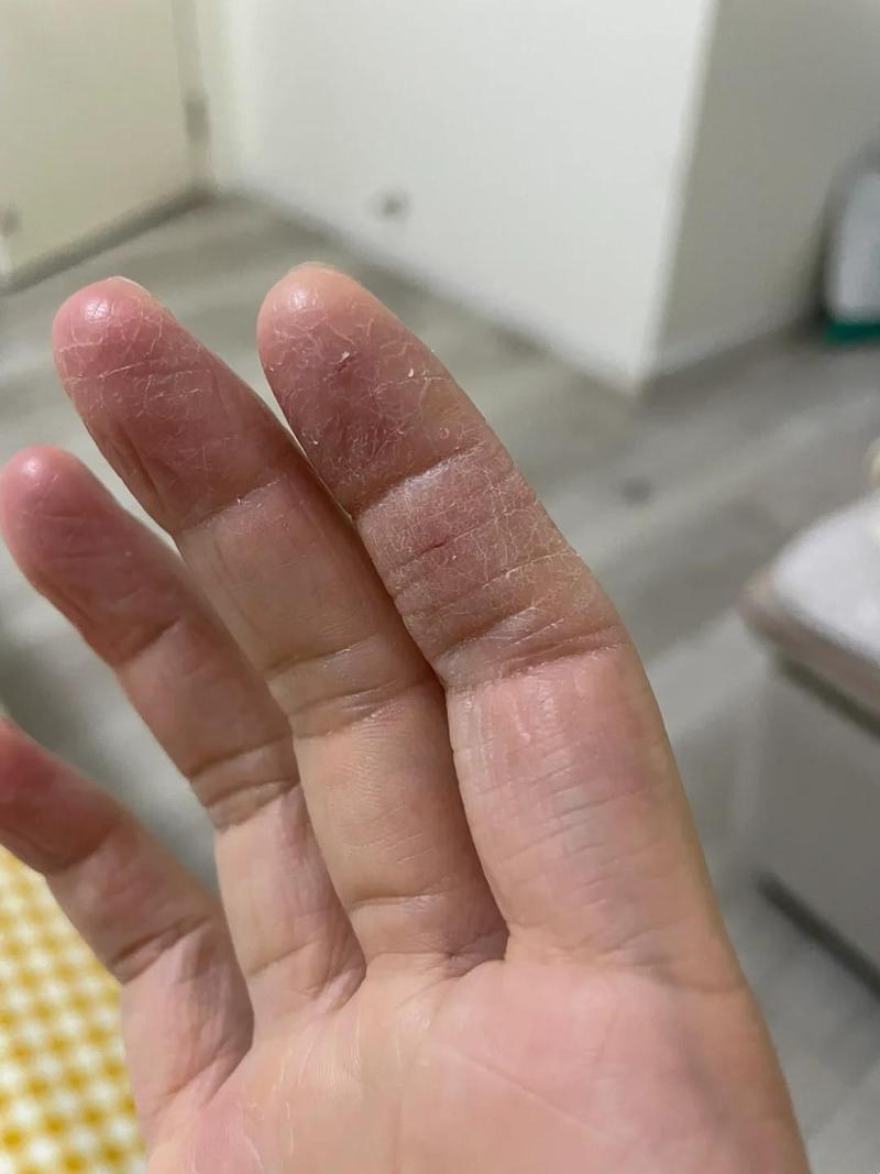 秋冬日常手部干燥脱皮特写