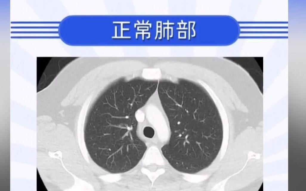 人工智能肺结节检测 CT 影像对比图
