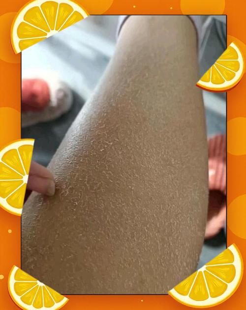 干燥季节小腿皮肤干燥掉屑实拍