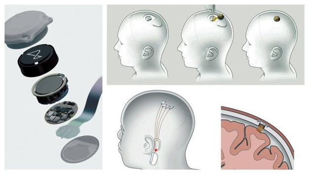 Neuralink脑机接口植入设备示意图