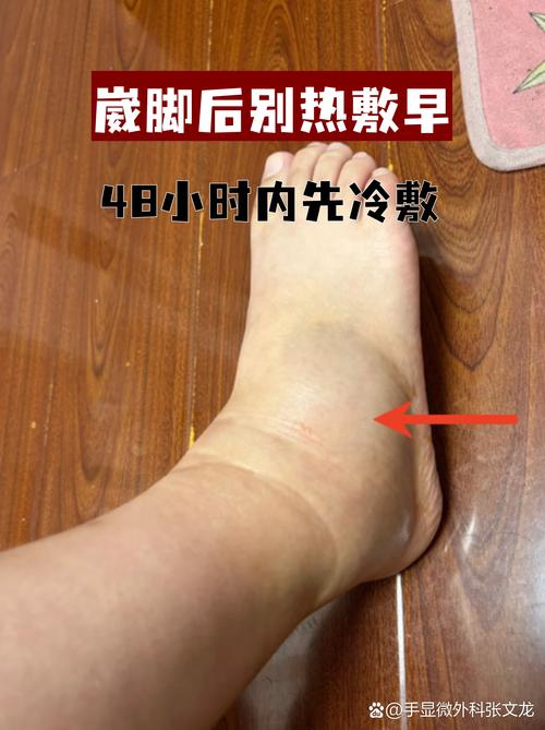 崴脚了别揉也别热敷