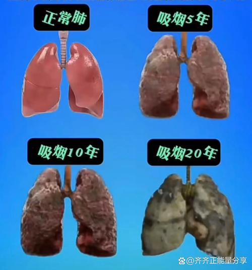 吸烟人群健康肺与损伤肺对比图