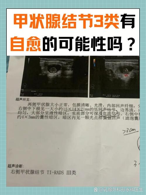 甲状腺结节3类超声报告实拍图
