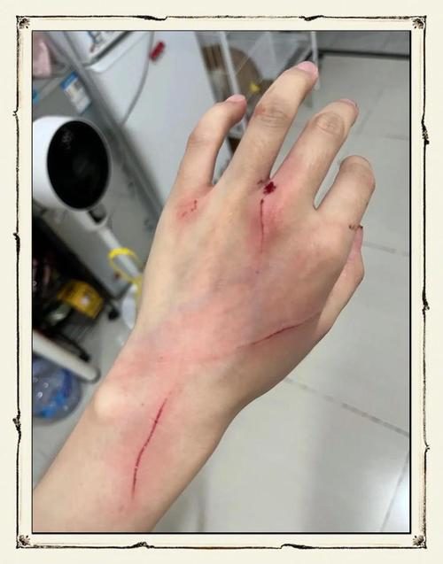 小朋友被家猫抓伤的胳膊浅划痕照片