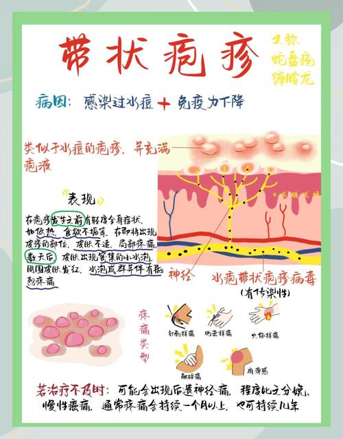 带状疱疹后遗神经痛早期神经影响示意图