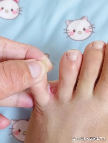 冬季泡脚后擦干脚趾缝实拍
