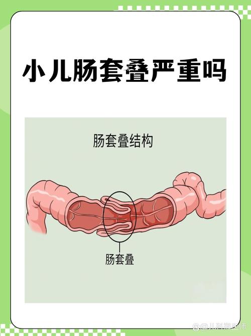婴儿肠套叠典型腹痛姿势示意图