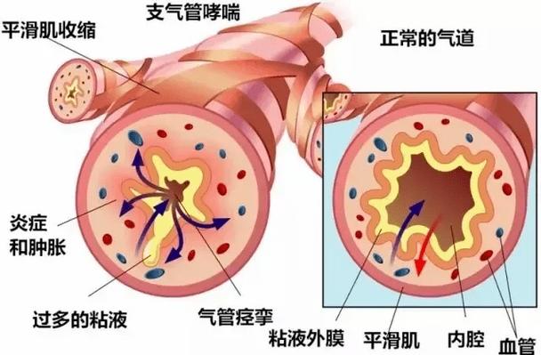 干燥空气影响呼吸道黏膜状态示意图
