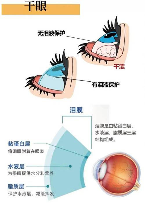 干眼症泪膜破裂对比示意图
