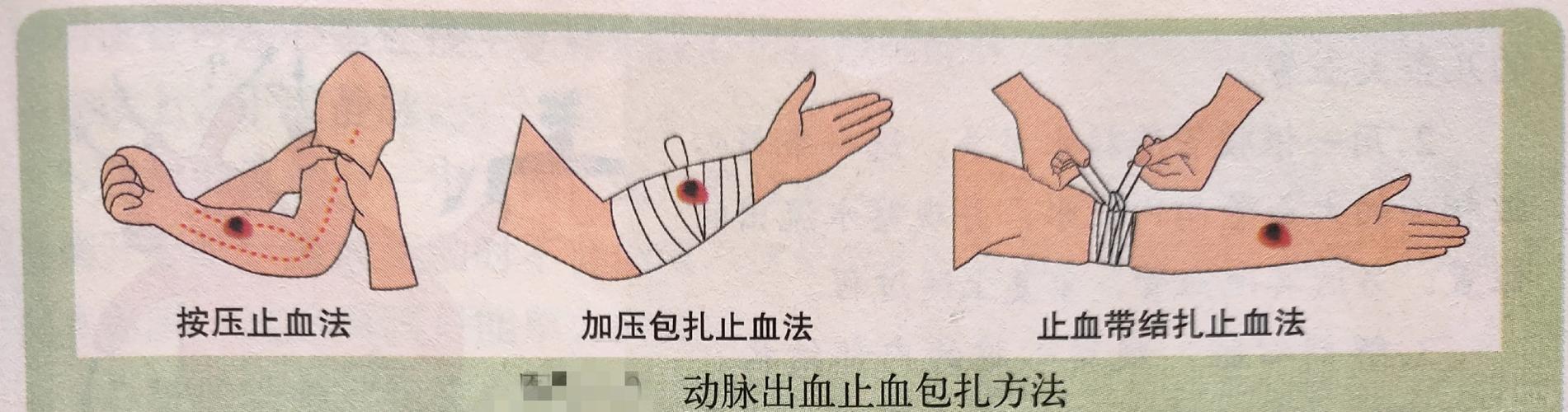 踩过坑才知道：这些止血误区千万别碰
