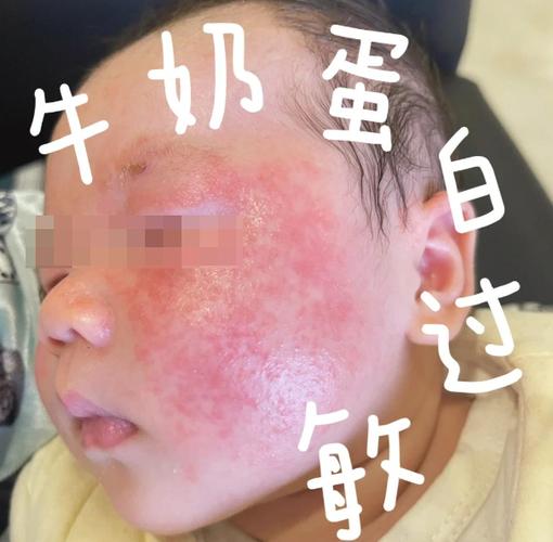 婴儿食物过敏面部红疹实拍