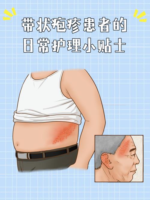 带状疱疹皮疹日常护理演示图