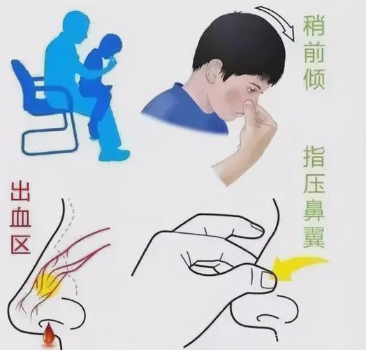 正确按压鼻翼止流鼻血示意图