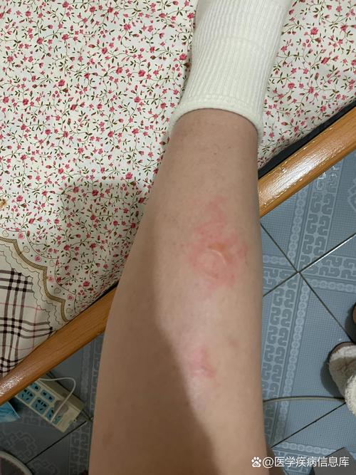 宠物低温烫伤的皮肤初期症状实拍