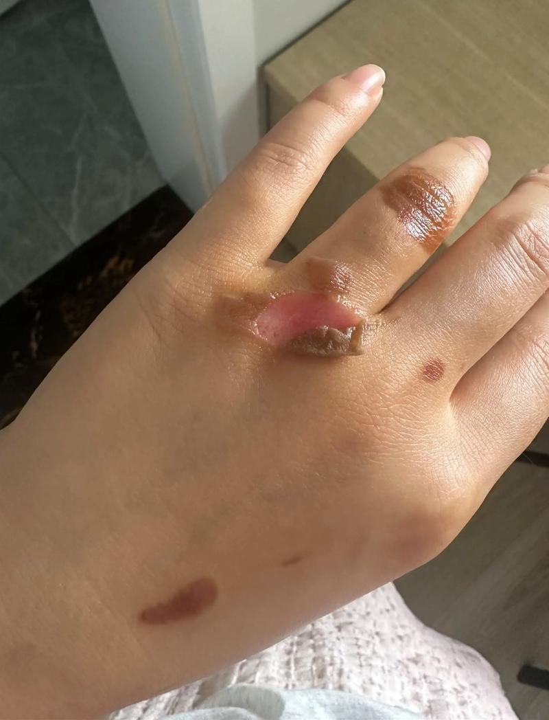 烫痕刮痕?先别急着崩溃