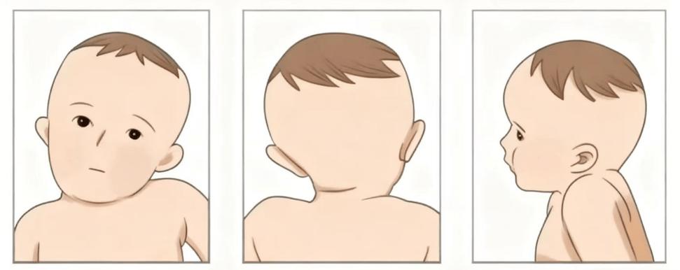 宝宝肌性斜颈抬头异常姿势示意图