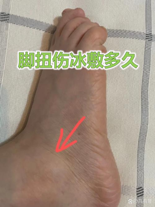 急性酸痛期：冰敷要踩对时间点