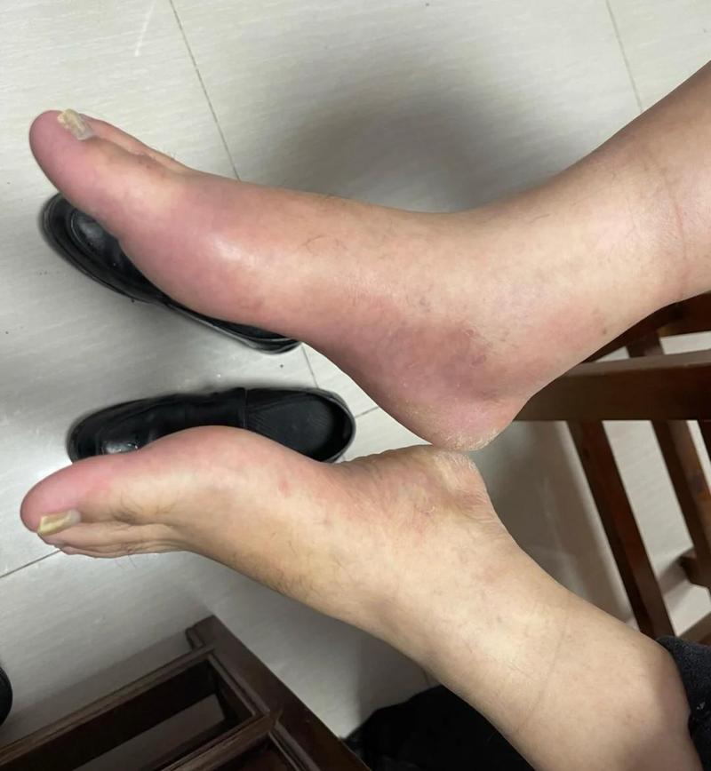 痛风急性发作脚踝关节肿胀图