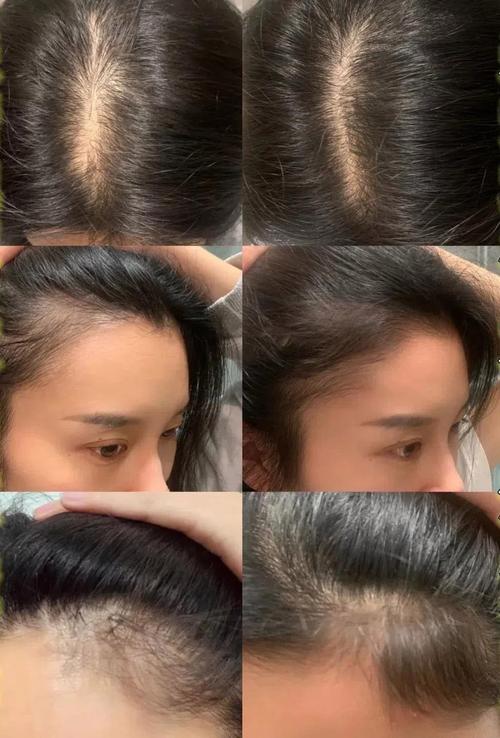 产后脱发雌激素水平变化对比图
